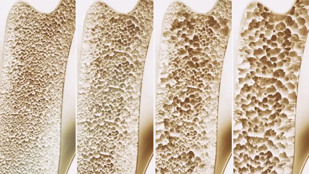 Osteoporosis 4 stages - 3d rendering - Nahrin